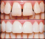 Porcelain Veneers, general and cosmetic dental services