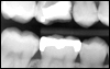 cavity fillings, fillings for cavities, general and cosmetic dental services